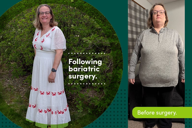 Julie Carolus before and after bariatric surgery