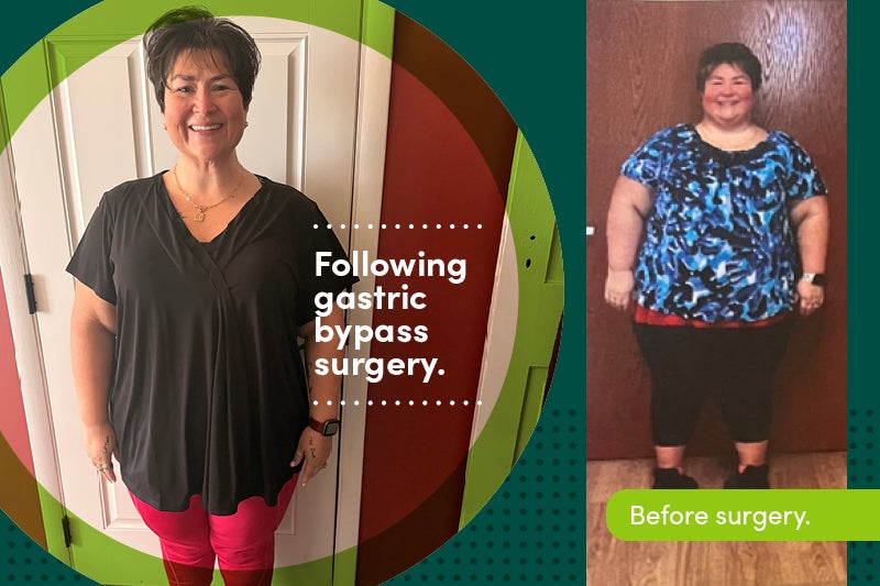 Rebecca Wiley before and after bariatric surgery