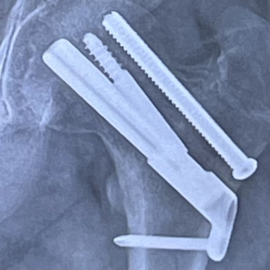 hip fix